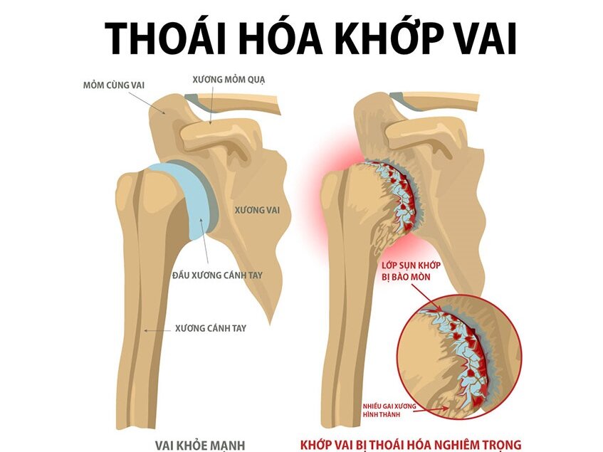 Thoái hóa khớp vai: Nguyên nhân, triệu chứng và uống thuốc gì?